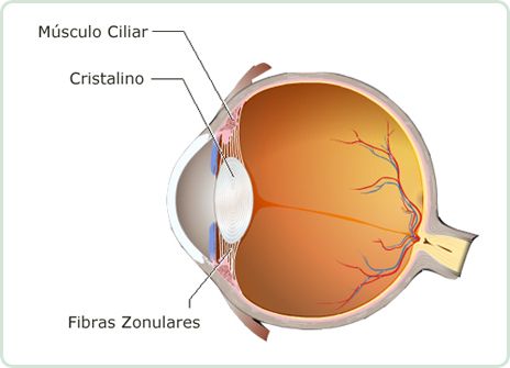 infografía del ojo con catarata