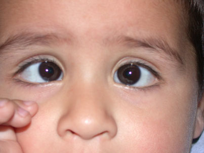 En esta foto se observa cómo los puntos blancos están desalineados uno del otro. En el ojo izquierdo está centrado, y en el ojo derecho está desplazado hacia afuera.
